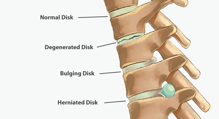 Levels of the spine discs