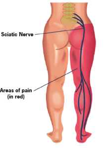 Sciatic nerve Image
